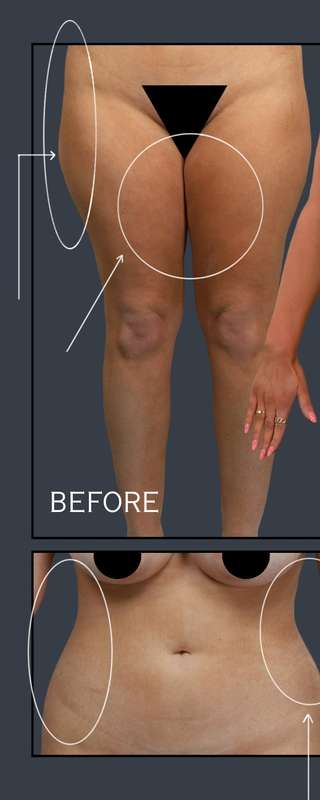 Liposuction Before & After Patient #7462