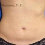 Liposuction Before & After Patient #7456