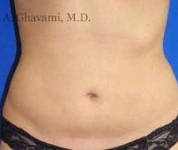 Liposuction Before & After Patient #7456