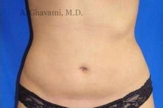 Liposuction Before & After Patient #7456