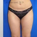 Liposuction Before & After Patient #7456