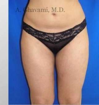Liposuction Before & After Patient #7456