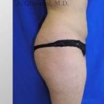 Liposuction Before & After Patient #7456