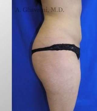 Liposuction Before & After Patient #7456