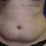 Liposuction Before & After Patient #7456
