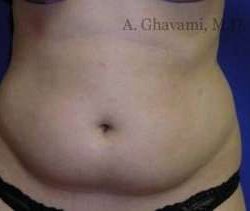 Liposuction Before & After Patient #7456