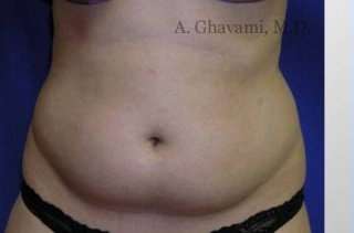 Liposuction Before & After Patient #7456