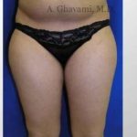 Liposuction Before & After Patient #7456