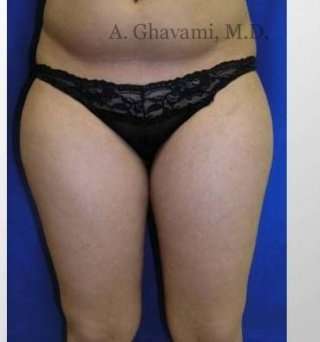 Liposuction Before & After Patient #7456