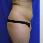 Liposuction Before & After Patient #7456
