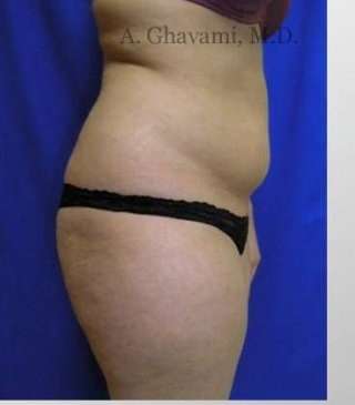 Liposuction Before & After Patient #7456