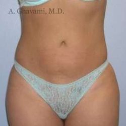 Liposuction Before & After Patient #7449