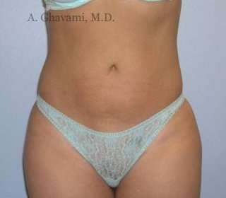 Liposuction Before & After Patient #7449