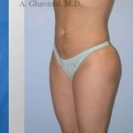 Liposuction Before & After Patient #7449