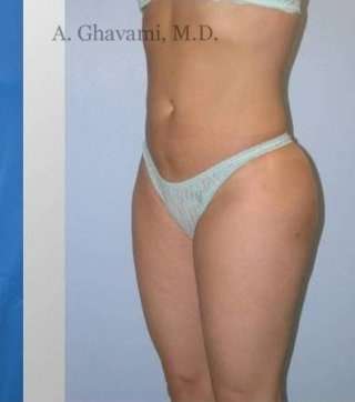 Liposuction Before & After Patient #7449