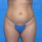 Liposuction Before & After Patient #7449