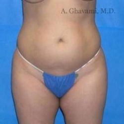 Liposuction Before & After Patient #7449