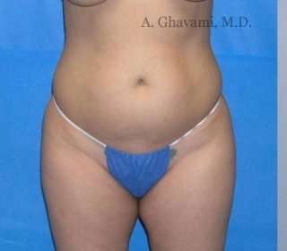 Liposuction Before & After Patient #7449