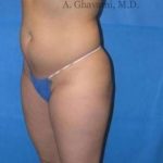 Liposuction Before & After Patient #7449