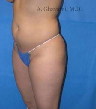 Liposuction Before & After Patient #7449