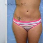 Liposuction Before & After Patient #7444