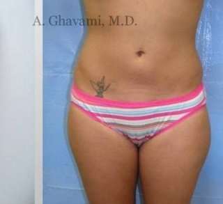 Liposuction Before & After Patient #7444