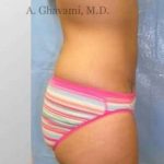 Liposuction Before & After Patient #7444