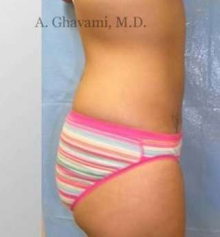 Liposuction Before & After Patient #7444