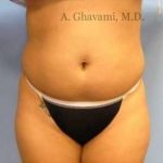Liposuction Before & After Patient #7444