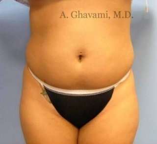 Liposuction Before & After Patient #7444