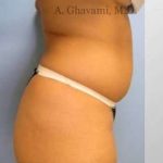 Liposuction Before & After Patient #7444