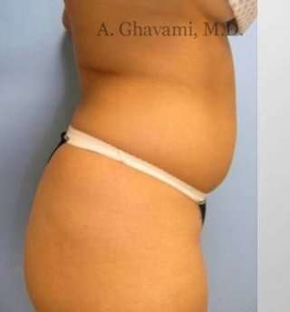 Liposuction Before & After Patient #7444