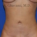 Liposuction Before & After Patient #7439