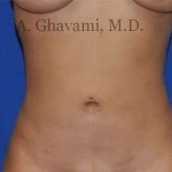 Liposuction Before & After Patient #7439