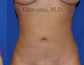 Liposuction Before & After Patient #7439