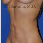 Liposuction Before & After Patient #7439