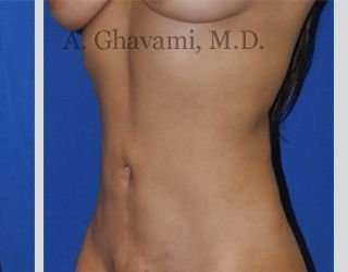 Liposuction Before & After Patient #7439