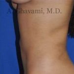 Liposuction Before & After Patient #7439