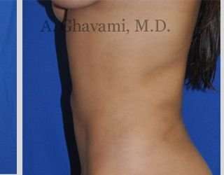 Liposuction Before & After Patient #7439