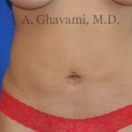 Liposuction Before & After Patient #7439