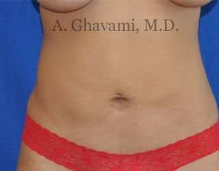 Liposuction Before & After Patient #7439
