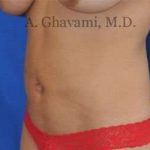 Liposuction Before & After Patient #7439