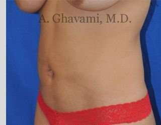Liposuction Before & After Patient #7439