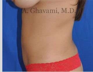 Liposuction Before & After Patient #7439