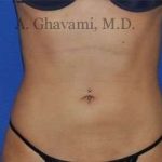 Liposuction Before & After Patient #7432