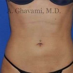 Liposuction Before & After Patient #7432