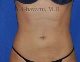Liposuction Before & After Patient #7432