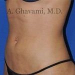 Liposuction Before & After Patient #7432