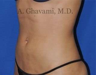Liposuction Before & After Patient #7432