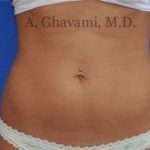 Liposuction Before & After Patient #7432